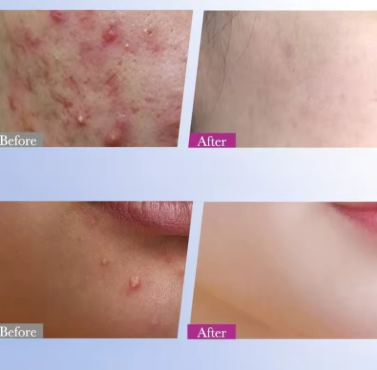 7/10/14Pcs Colorful Star Acne Patch Improve Women Skin Hydrocolloid Acne Tool Invisible Acne Cover Pimple Patch Skin Care Tools